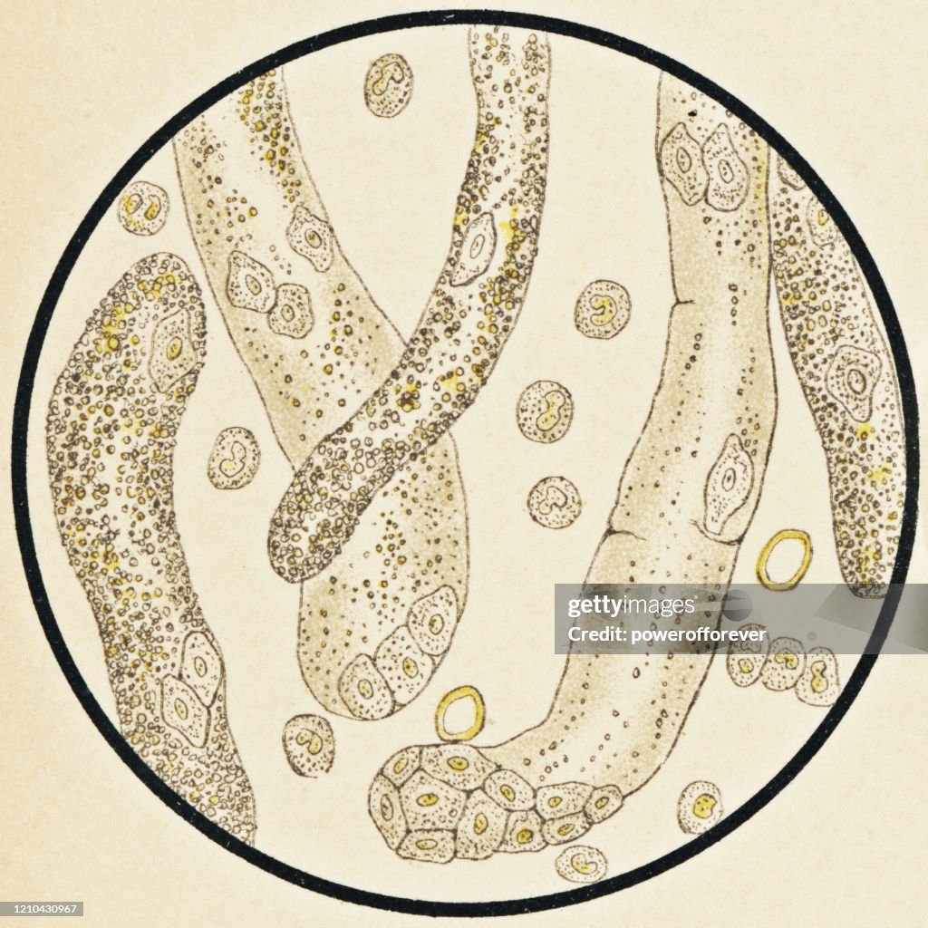 Microscopic View of Human Urinary Sediment from a Patient with Albuminuria - 19th Century