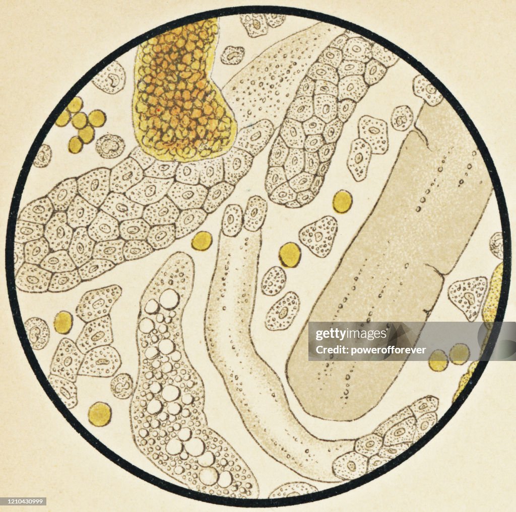 Microscopic View of Human Urinary Sediment from a Patient with Nephrosis - 19th Century