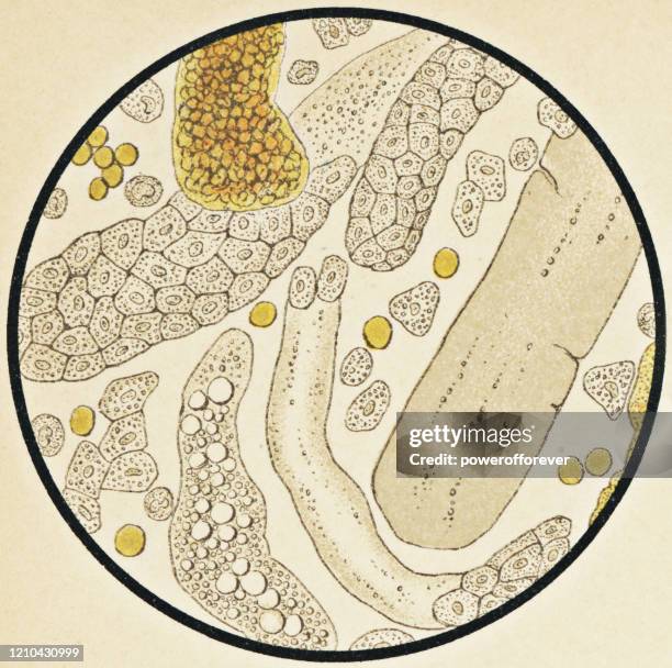 microscopic view of human urinary sediment from a patient with nephrosis - 19th century - white blood cell stock illustrations