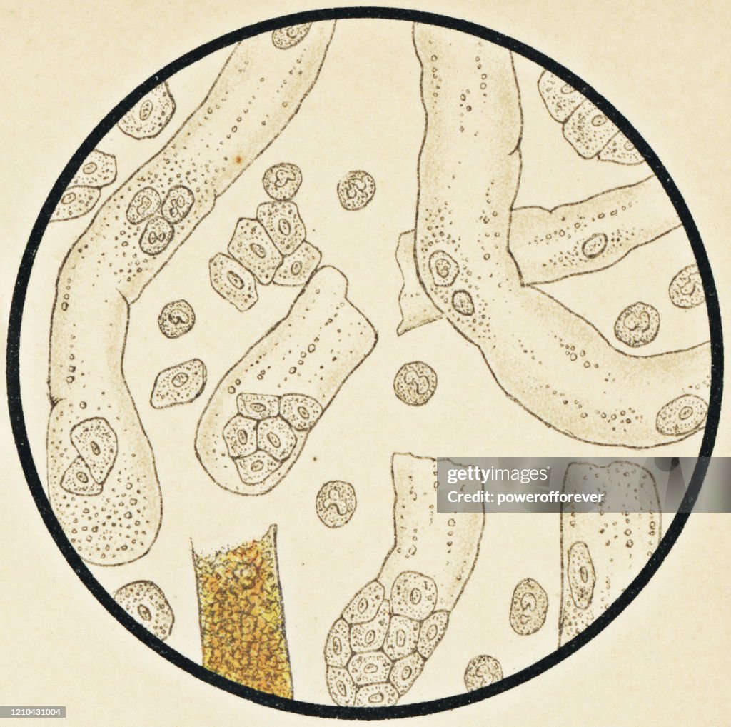 Microscopic View of Human Urinary Sediment from a Patient with Chronic Kidney Disease - 19th Century