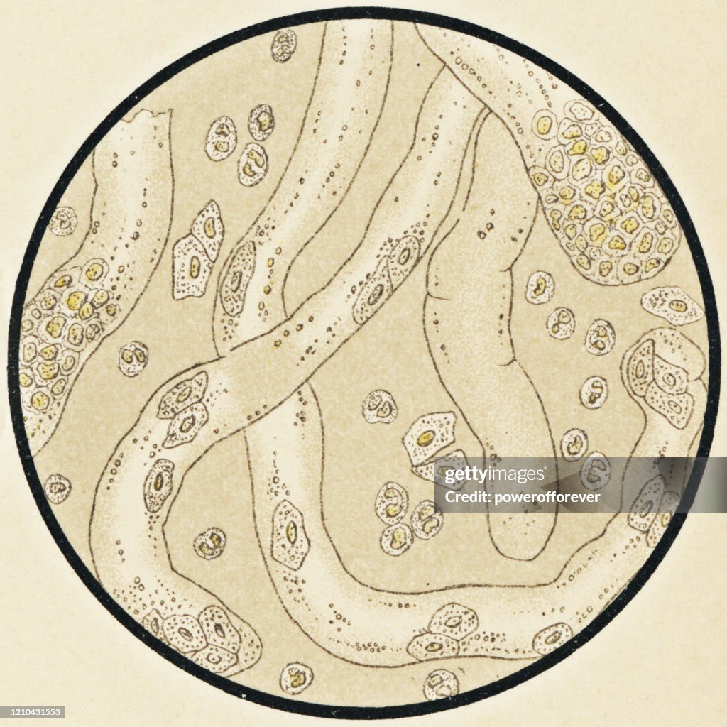 Microscopic View of Human Urinary Sediment from a Patient with Amyloidosis of the Kidney - 19th Century
