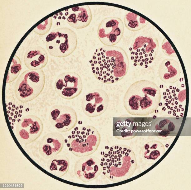 stockillustraties, clipart, cartoons en iconen met microscopische weergave van menselijke witte bloedcellen en neisseria gonorrhoeae bacteriën van een patiënt met gonorroe, gram stain methode - 19e eeuw - neisseria gonorrhoeae