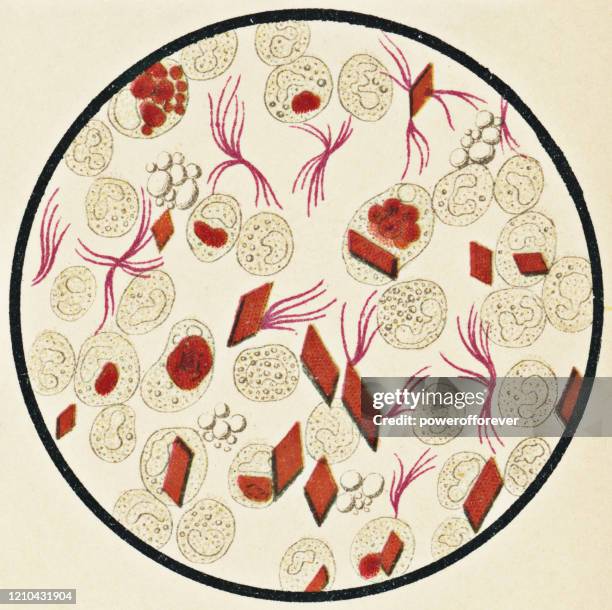 mikroskopische ansicht von menschlichen blutkörperchen und hämatoidin-kristallen von einem patienten mit sarkom - 19. jahrhundert - medical diagram stock-grafiken, -clipart, -cartoons und -symbole