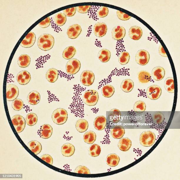 stockillustraties, clipart, cartoons en iconen met microscopische weergave van menselijke bloedcellen en staphylococcus aureus bacteriën van een patiënt die een staph infectie met tyfus ontwikkeld - 19e eeuw - staphylococcus aureus