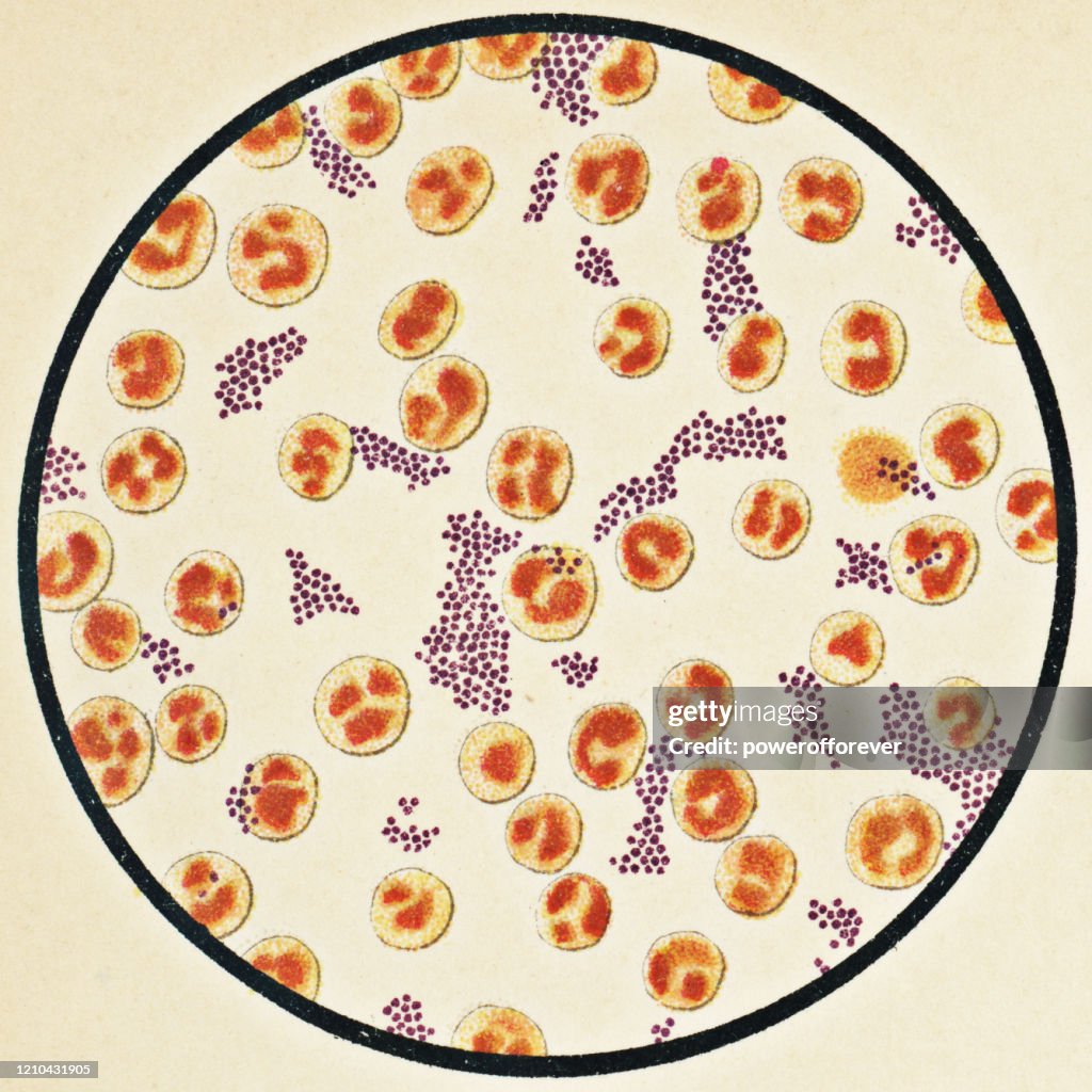 Microscopic View of Human Blood Cells and Staphylococcus Aureus Bacteria from a Patient that Developed a Staph Infection with Typhoid Fever - 19th Century