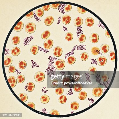 Microscopic View of Human Blood Cells and Staphylococcus Aureus Bacteria from a Patient that Developed a Staph Infection with Typhoid Fever - 19th Century Microscopic View of Human Blood Cells and Staphylococcus Aureus Bacteria from a Patient that Developed a Staph Infection with Typhoid Fever - 19th Century
