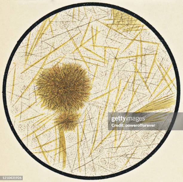 stockillustraties, clipart, cartoons en iconen met microscopische weergave van urinezuurkristallen van een tophus nodule op een patiënt met jicht - 19e eeuw - gout