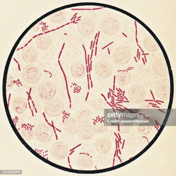 stockillustraties, clipart, cartoons en iconen met microscopische weergave van menselijke bloedcellen en proteus vulgaris bacteriën van een patiënt met peritonitis - 19e eeuw - proteus vulgaris