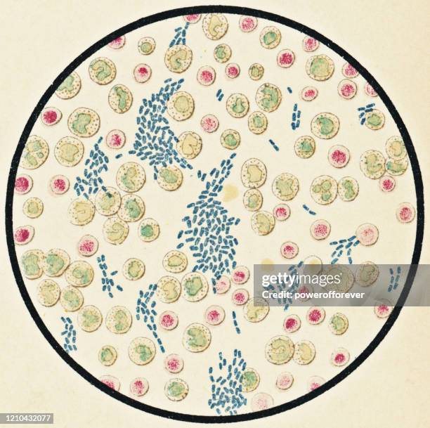 mikroskopische ansicht menschlicher blutkörperchen und salmonellen typhi bakterien von einem patienten mit typhus - 19. jahrhundert - salmonella bacteria stock-grafiken, -clipart, -cartoons und -symbole