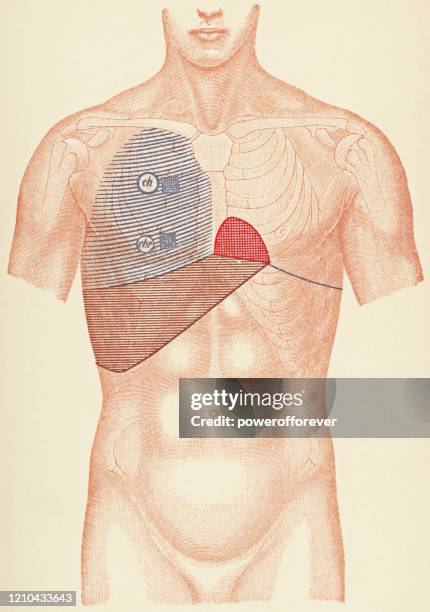 medical illustration of human torso with stethoscope and percussion points for a patient with lobar pneumonia, front view - 19th century - anatomy charts stock illustrations