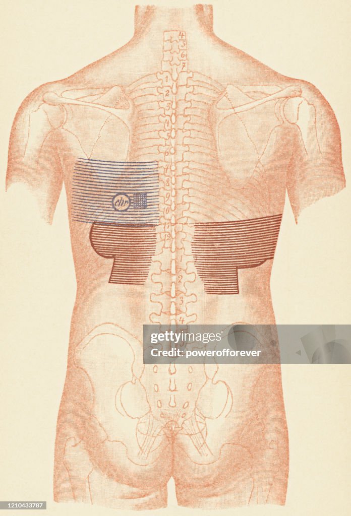 Medical Illustration of Human Torso with Stethoscope and Percussion Points for a Patient with a Pleural Effusion from Tuberculosis, Rear View - 19th Century