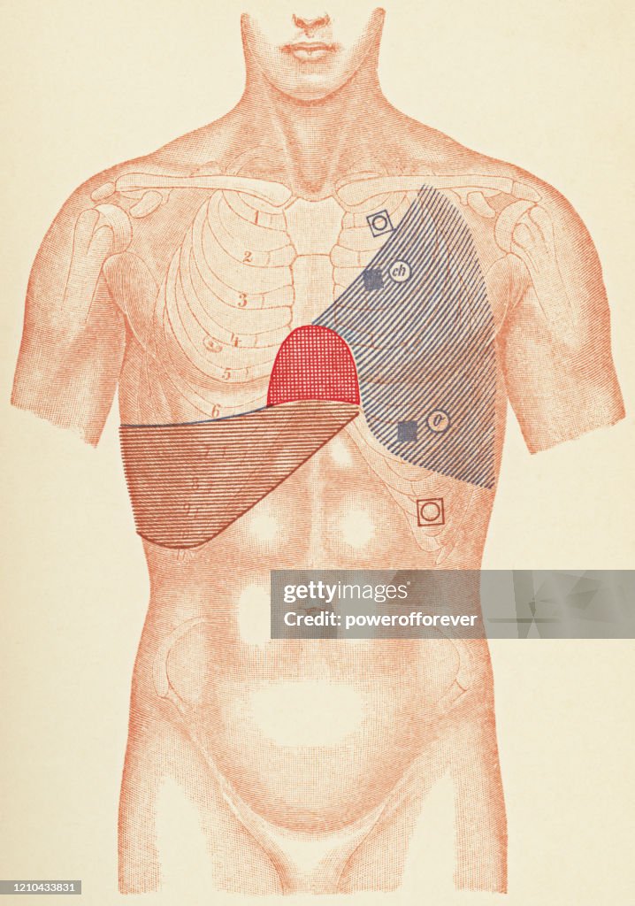 Medical Illustration of Human Torso with Stethoscope and Percussion Points for a Patient with a Pleural Effusion from Tuberculosis, Front View - 19th Century
