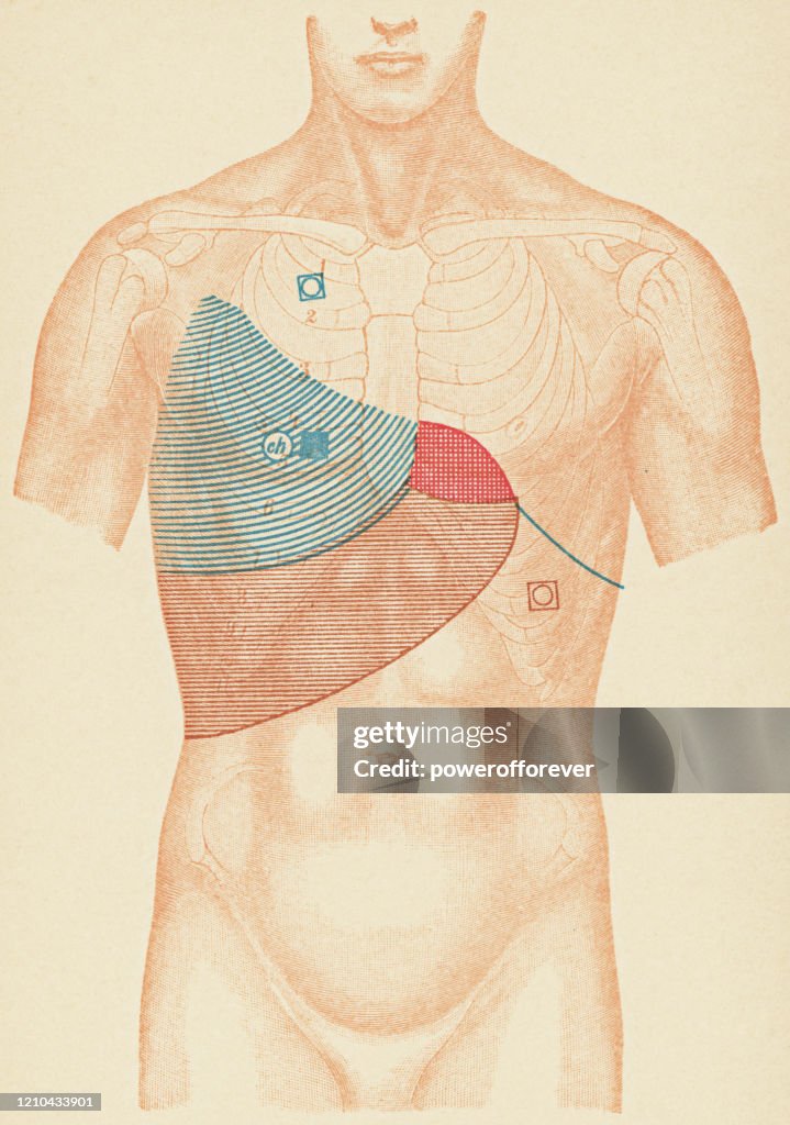 Medical Illustration of Human Torso with Stethoscope and Percussion Points for a Patient with a Pleural Effusion from Tuberculosis, Front View - 19th Century