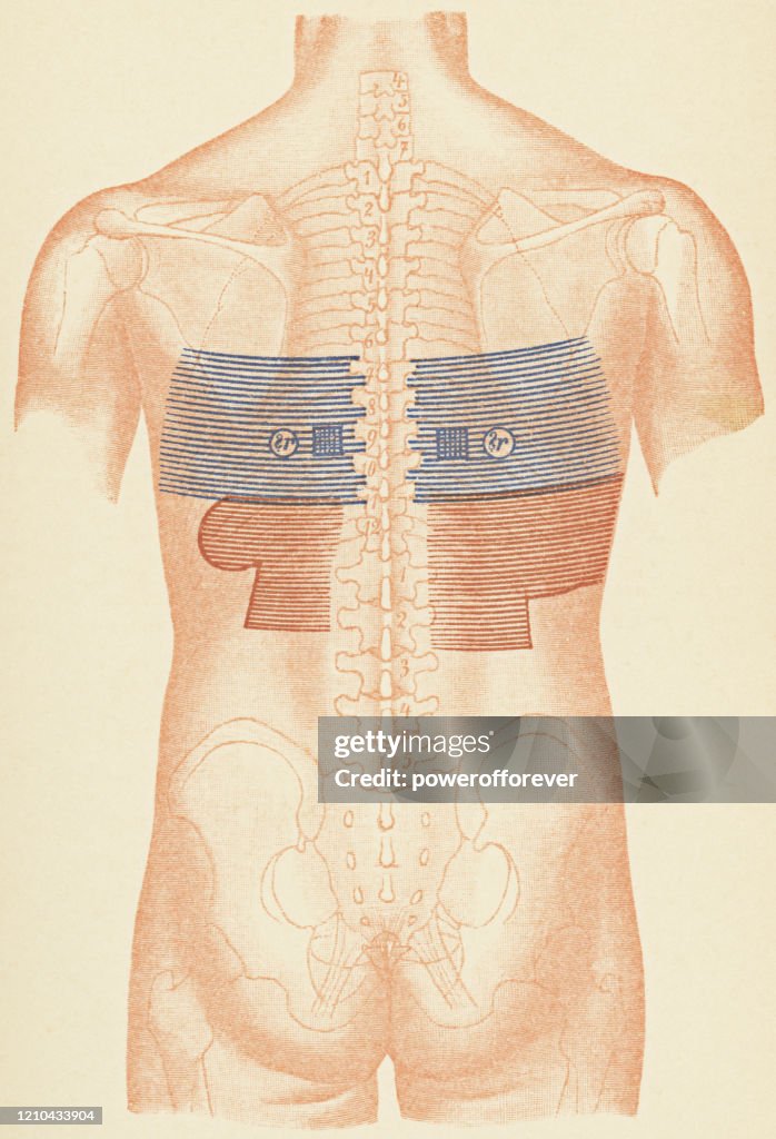 Medical Illustration of Human Torso with Stethoscope and Percussion Points for a Patient with a Hydrothorax from Heart Failure, Rear View - 19th Century