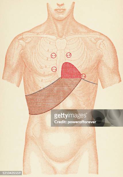 medizinische illustration des menschlichen torso mit stethoskop und percussion-punkte für einen patienten mit hypertropher kardiomyopathie, frontansicht - 19. jahrhundert - oberkörper stock-grafiken, -clipart, -cartoons und -symbole