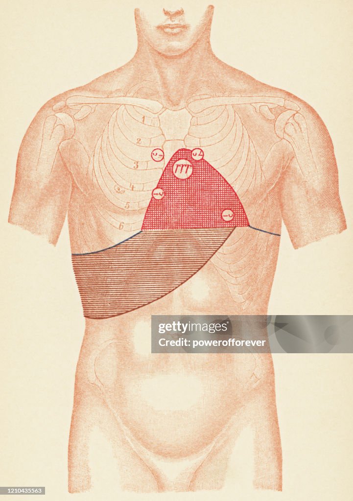 Medical Illustration of Human Torso with Stethoscope and Percussion Points for a Patient with Pericarditis from Tuberculosis, Front View - 19th Century