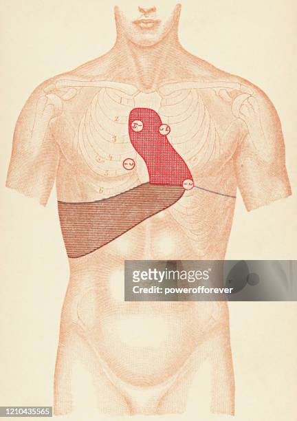 medical illustration of human torso with stethoscope and percussion points for a patient with a thoracic aortic aneurysm, front view - 19th century - abdomen diagram stock illustrations