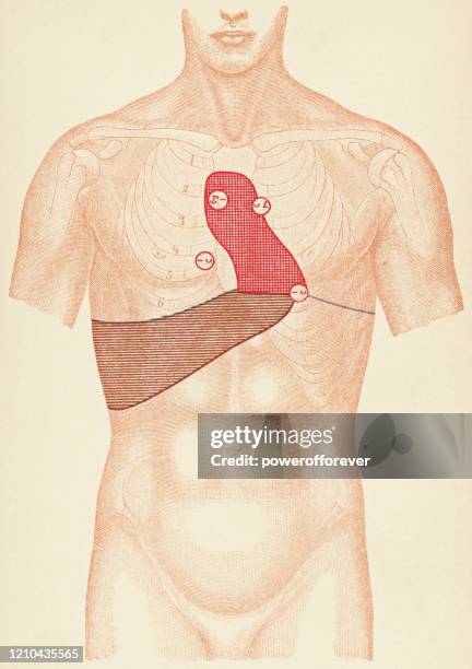 medical illustration of human torso with stethoscope and percussion points for a patient with a thoracic aortic aneurysm, front view - 19th century - thoracic aorta aneurysm stock illustrations
