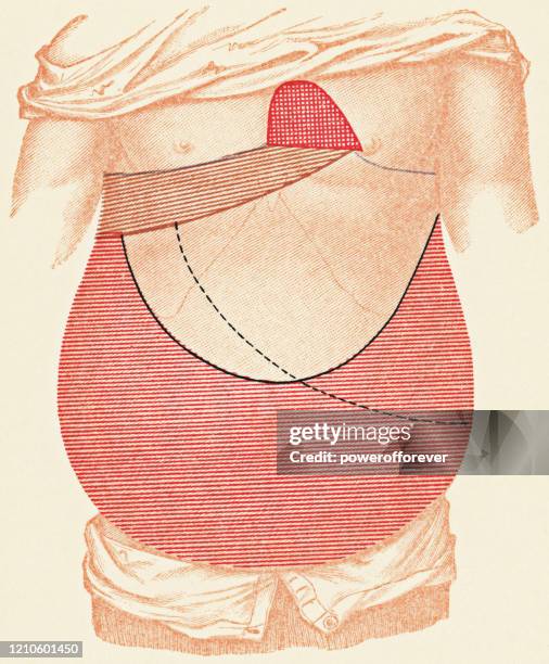 medical illustration of human torso with percussion exam points for a patient with ascites, front view - 19th century - percussion abdomen stock illustrations