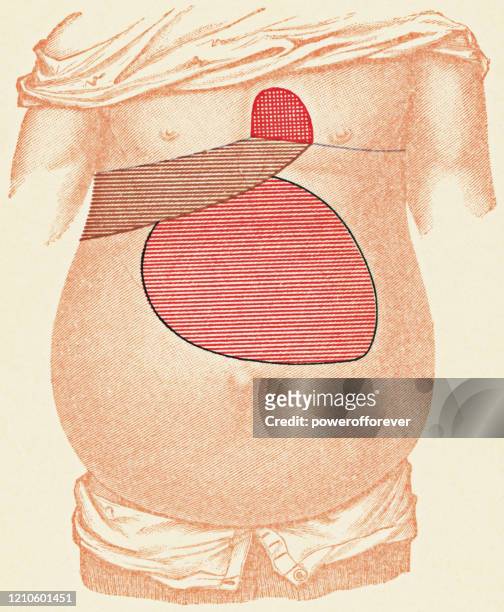 medizinische illustration des menschlichen torso mit percussion-prüfungspunkte für einen patienten mit einer bauchspeicheldrüsenzyste, frontansicht - 19. jahrhundert - cyst stock-grafiken, -clipart, -cartoons und -symbole