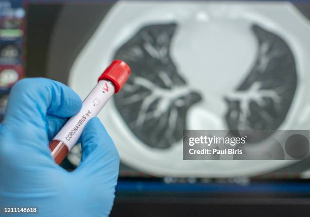 coronarovirus, covid-19, test tube for coronavirus 2019-ncov analysis - covid lung stock pictures, royalty-free photos & images