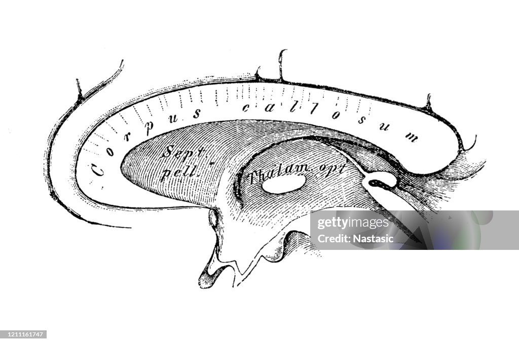 The corpus callosum (Latin for "tough body"), also callosal commissure, is a wide, thick nerve tract, consisting of a flat bundle of commissural fibers, beneath the cerebral cortex in the brain