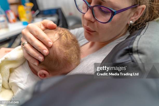 mutter mit blick auf ihr neugeborenes baby kopf, das dermatologische problem hat cradle cap seborrhoische dermatitis - eczema child stock-fotos und bilder