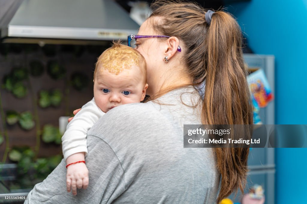 Madre sosteniendo cabeza de bebé recién nacido con problema dermatológico Cradle Cap Dermatitis seborreica