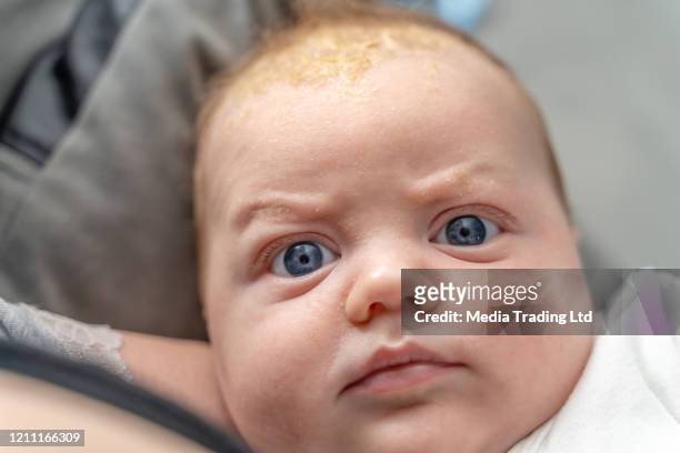 lindo gordito cabeza de bebé con problema dermatológico cradle cap dermatitis seborreica de cerca - dermatitis seborreica fotografías e imágenes de stock