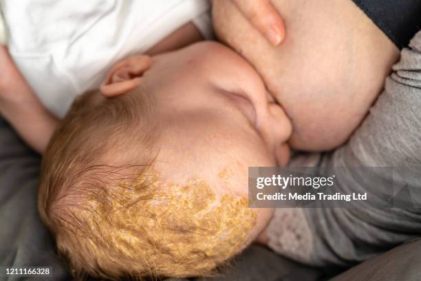 baby with awful dermatologic problem cradle cap seborrheic dermatitis eating from mum's breast breastfeeding - scratching scalp stock pictures, royalty-free photos & images
