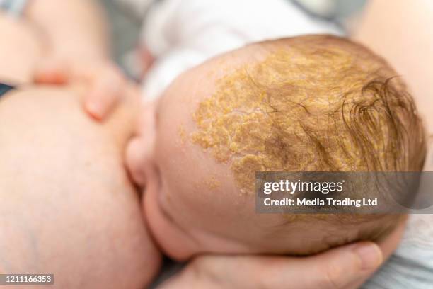 starke cradle cap seborrhoische dermatitis auf baby kopf kopf stillen nahaufnahme - eczema child stock-fotos und bilder