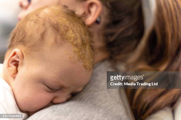 madre sosteniendo a su bebé que tiene problema dermatológico cradle cap dermatitis seborreica - dermatitis seborreica fotografías e imágenes de stock