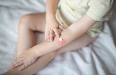 A small child smears redness on the hand with baby cream. The concept of treatment and skin care with a cream, rash and peeling in children, dermatology