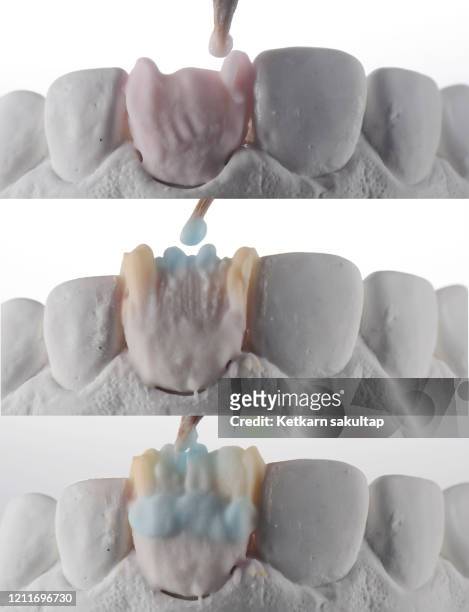 close up shot of ceramic build up procedure of ceramic veneer or ceramic crown. - gingivitis stock-fotos und bilder