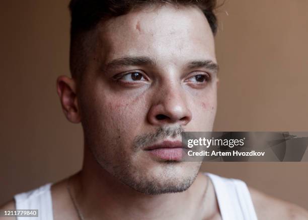 unretouched adjective portrait of young man looking aside - narbe hautmerkmal stock-fotos und bilder