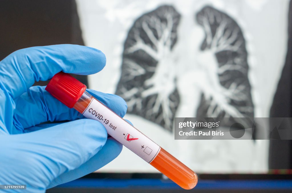 Coronavirus diagnosed x-ray cat tomography, CT scan, negative blood test for Coronavirus