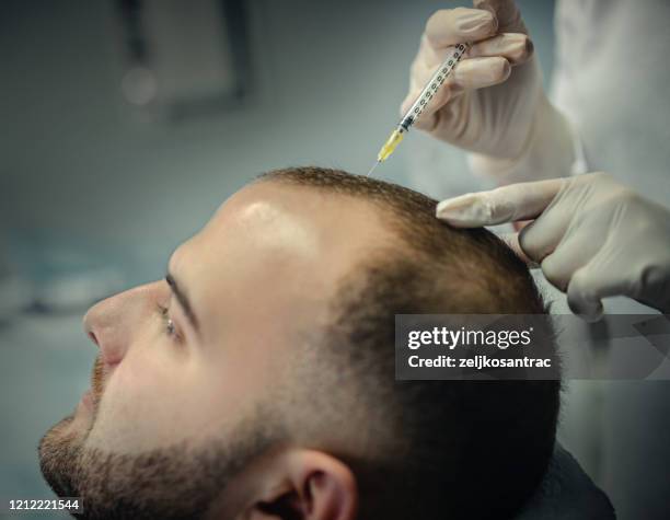 terapia cutánea autosérica - parcialmente calvo fotografías e imágenes de stock