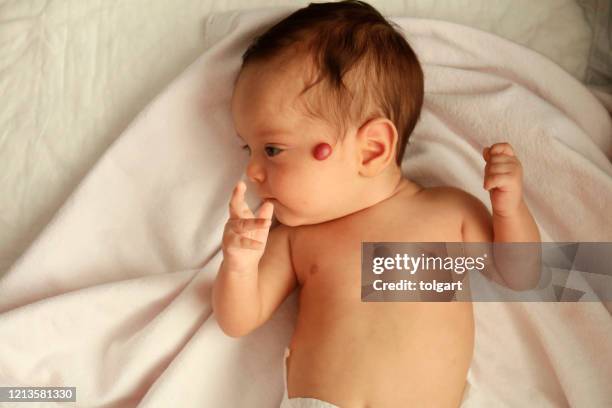 hemangioma on the face of a baby - endothelial function stock pictures, royalty-free photos & images