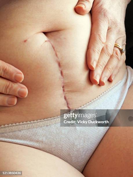 hysterectomy scar - histerectomia fotografías e imágenes de stock