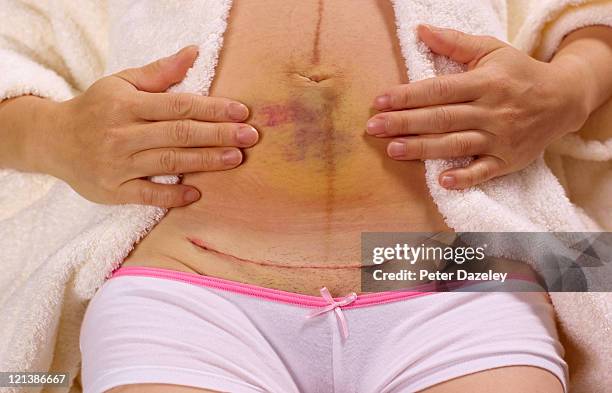 mother showing bruising and caesarian scar - women bruise stock pictures, royalty-free photos & images