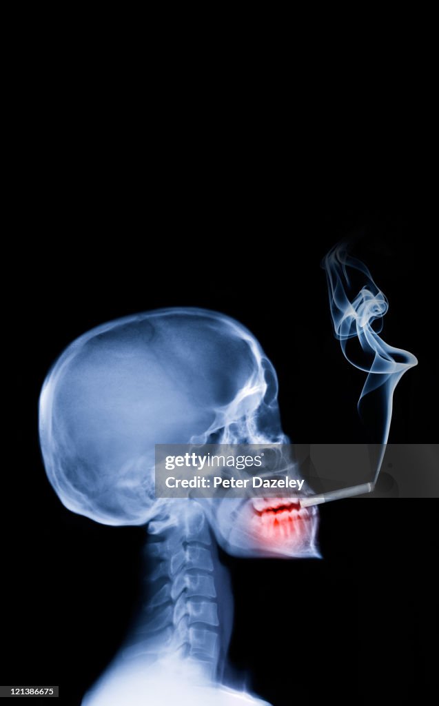 Smoking and mouth cancer