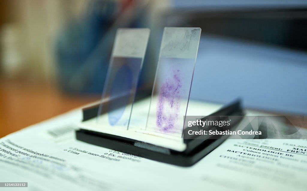 Stained glass slides of peripheral blood smear with violet leishman giemsa stain in hematology pathology laboratory coronavirus, covid-19 respiratory syndrome coronavirus 2 (SARS-CoV-2)
