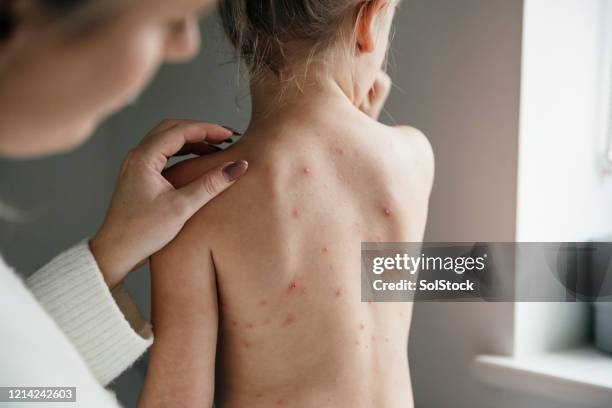 lassen sie mammy überprüfen - chickenpox stock-fotos und bilder