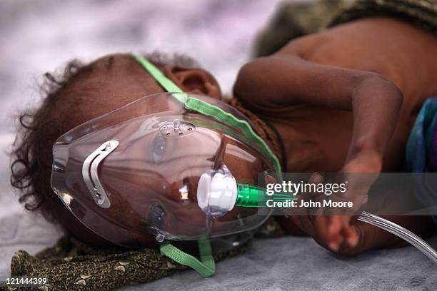 Young malnourished girl breathes in oxygen at a Turkish field hospital on August 19, 2011 in Mogadishu, Somalia. The tented hospital, opened this...