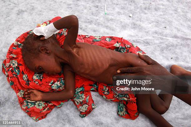 Fartun Osman is comfoted by her mother Fadima Omar at a Turkish field hospital on August 19, 2011 in Mogadishu, Somalia. The tented hospital, opened...