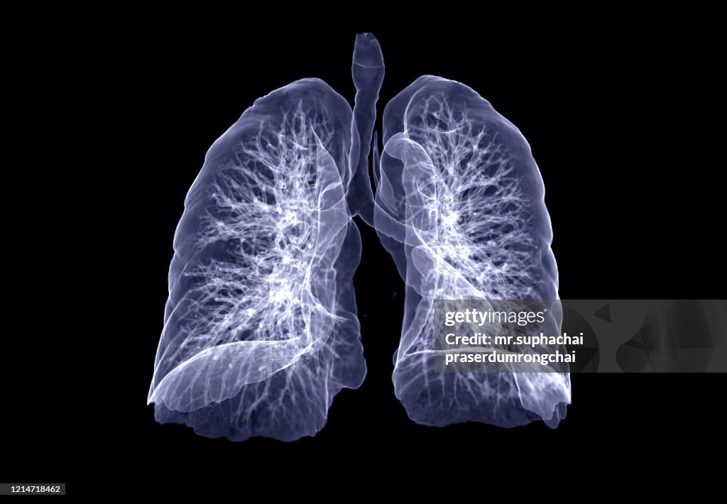 CT lung 3d rendering imaging.