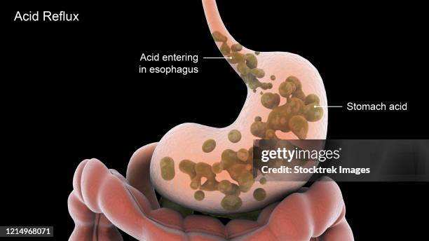 biomedical illustration of acid reflux in the stomach. - gastric acid stock illustrations