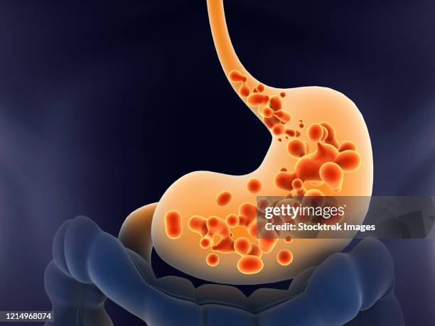 medical illustration of acid reflux in human stomach. - acid reflux stock-grafiken, -clipart, -cartoons und -symbole