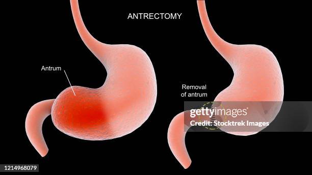 illustration showing antrectomy procedure of the human stomach. - abdomen surgery stock illustrations