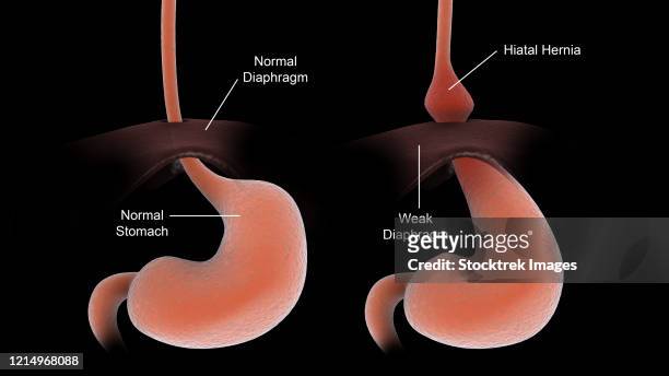 ilustraciones, imágenes clip art, dibujos animados e iconos de stock de a healthy human stomach compared to an unhealthy human stomach with hiatal hernia. - hernia de hiato